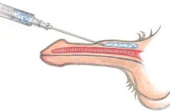 A dangerous method of penis enlargement with vaseline injections